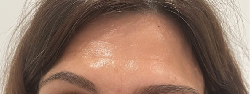 botox-front-avant.png